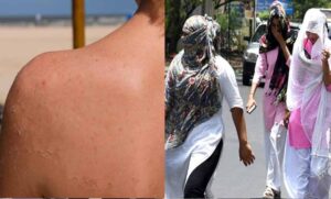 भीषण-गर्मी-का-असर,-सनबर्न-के-मरीज-बढ़े;-त्वचा-में-जलन-और-धब्बों-की-शिकायतें